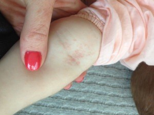Margot was showing some signs of GVHD on her skin - but the question was whether the rash / reaction was sufficient to cause GVL